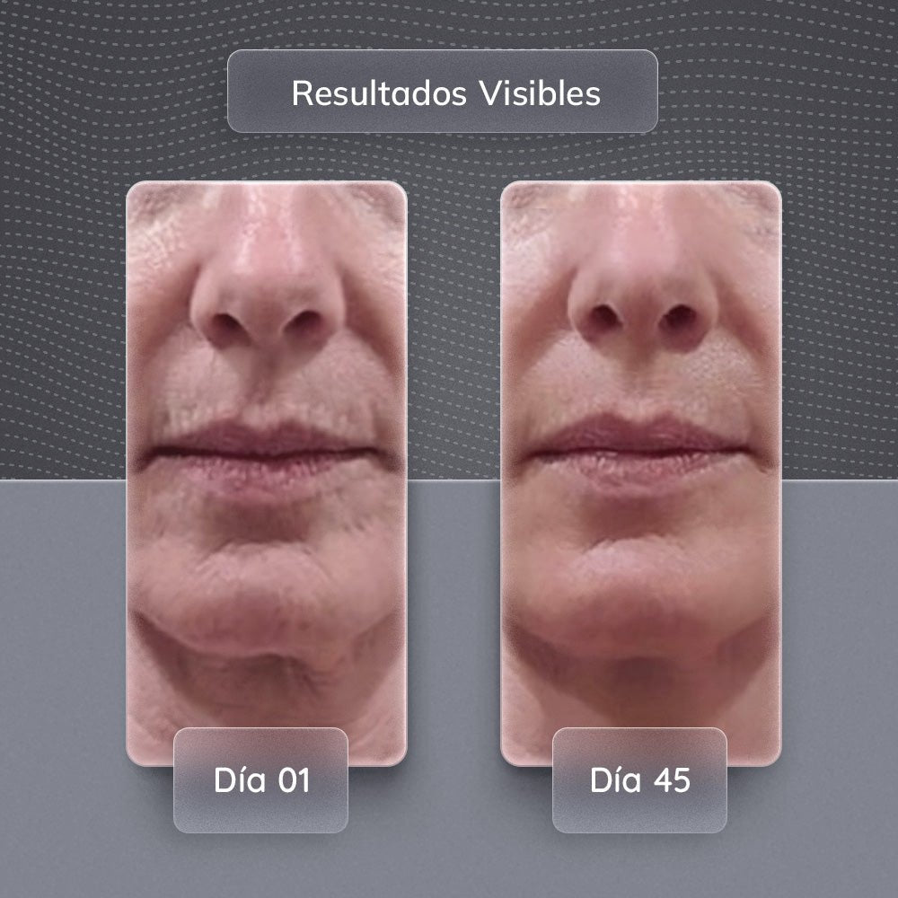 Dispositivo de Rejuvenecimiento Facial