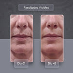 Dispositivo de Rejuvenecimiento Facial