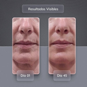 Dispositivo de Rejuvenecimiento Facial